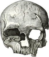 Damaged Skull Of Cro Magnon's wife