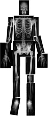 X-ray of Full Body