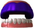 Mouthguard on Top Teeth Illustration