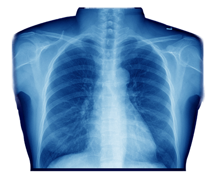 X-ray of Chest