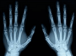 X-ray of Both Hands