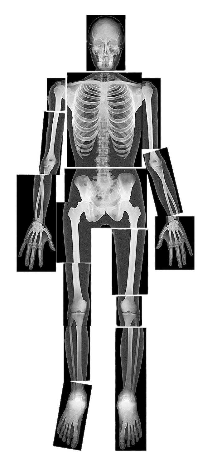X-ray of Full Body