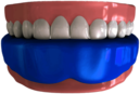Mouthguard on Lower Teeth Illustration