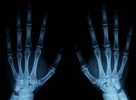 X-ray of Both Hands