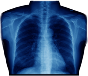 X-ray of Chest