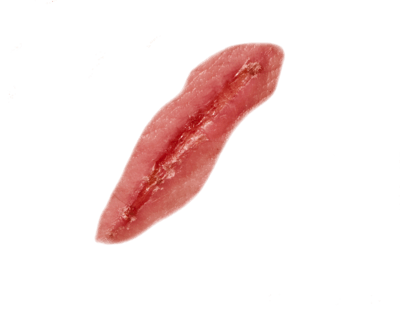 Wound Scar