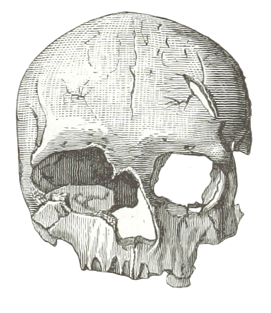 Damaged Skull Of Cro Magnon's wife