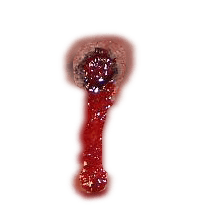 Bleeding Wound